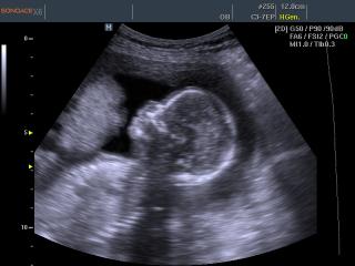 Fetal profile, B-mode
