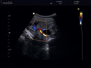 Bladder and 2 umbilical arteries, power doppler