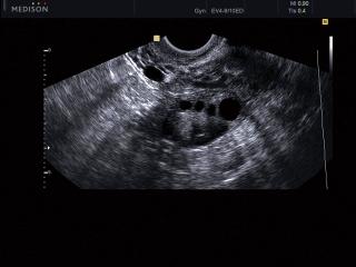 Ovary, B-mode