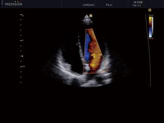 Heart (4 chamber view), color doppler