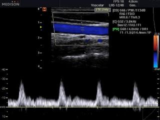 Common carotid artery, CFM & PW