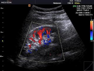 Kidney, color doppler