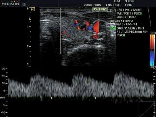 Thyroid blood flow, color doppler