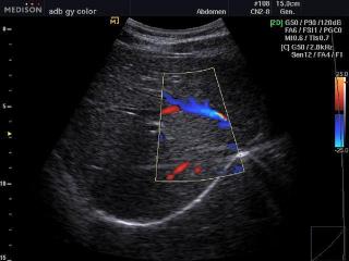 Liver blood flow, color doppler