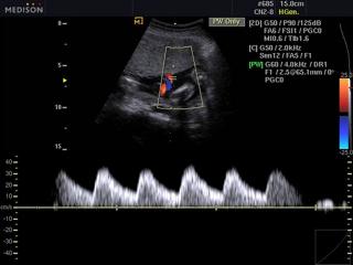 Umbilical vessels, CFM & PW