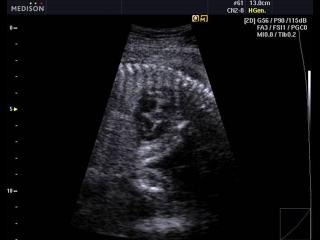 Fetus - heart, Quick FSI