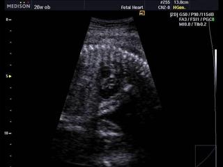 Fetal heart, B-mode