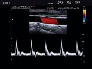 Common carotid artery, CFM & PW