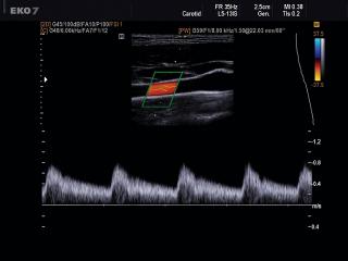 Internal carotid artery, CFM & PW