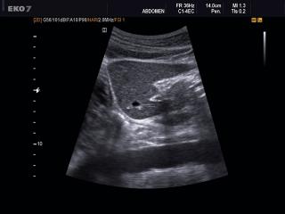 Liver - left lobe, B-mode