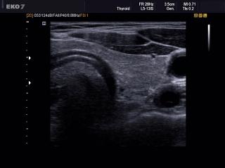 Thyroid, B-mode