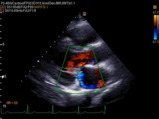 Mitral regurgitation, color doppler