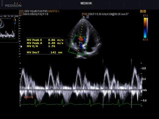 Transmitral flow, CFM & PW