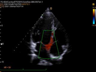 Interventricular septum, TDI color doppler