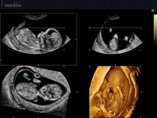 Fetus - 13 weeks, MPR, HDVI