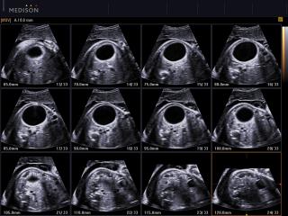 Fetus - abdominal cyst, MSV