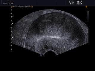 Uterine myoma, B-mode