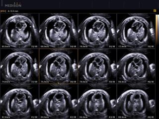 Fetus - bilateral pleural effusion, MSV