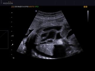 Fetгы - bilateral pleural effusion, B-mode