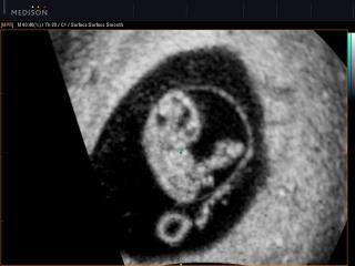 Fetus - 8 weeks, B-mode