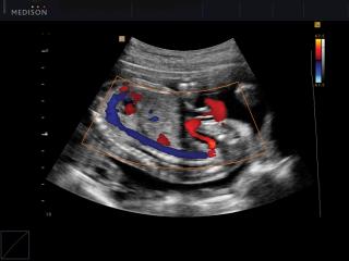 Fetal blood circulation, color doppler
