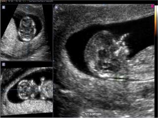 Fetus - nuchal translucency, Volume NT