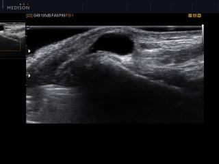 Ganglion cyst, B-mode