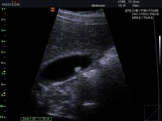 Gallbladder stone, B-mode