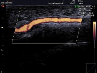 Blood flow in the soft tissues of the wrist, power doppler