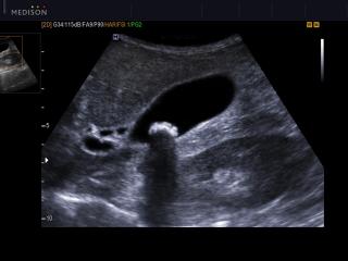 Gallbladder stone, B-mode