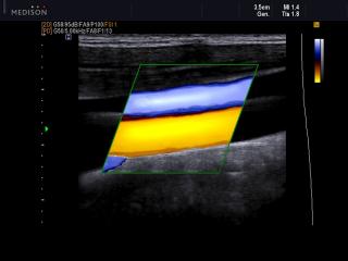 Common carotid artery and jugular vein, DPDI