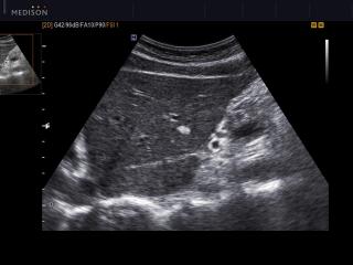 Liver - hemangioma, B-mode