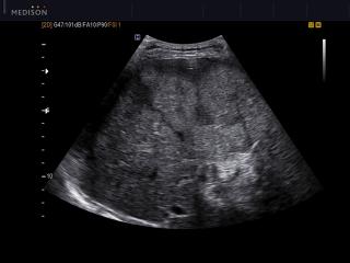 Liver - multiple masses, DMR