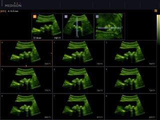 Gallbladder stones, MSV & 3D