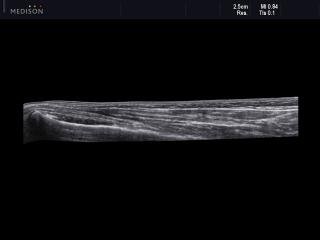 Soft tissue limb, panoramic view