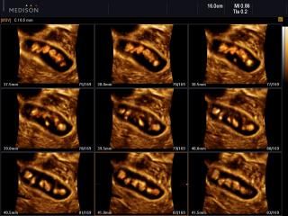 Multiple gallbladder stones, MSV+HDVI & 3D