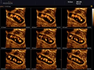 Multiple gallbladder stones, MSV+HDVI & 3D