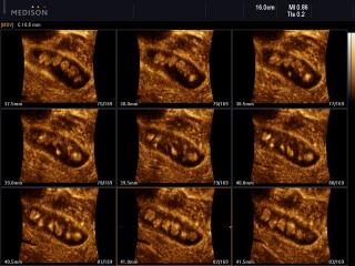 Multiple gallbladder stones, MSV & 3D