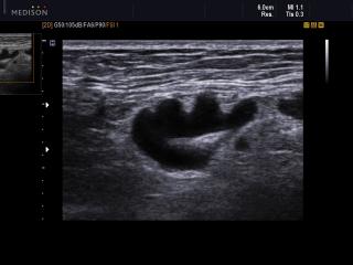 Neck side lymphadenitis, B-mode