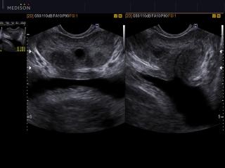 Prostatic utricle cyst, B-mode