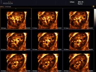 Right kidney, MSV & 3D