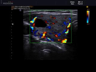 Thyroid - colloid nodes, color doppler