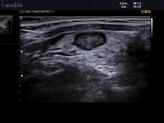 Thyroid benign nodule, B-mode