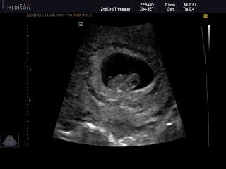 Fetus - 8 weeks, B-mode