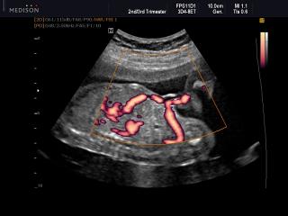 Fetal blood circulation, power doppler