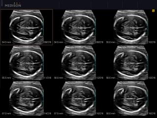 Fetal brain, MSV