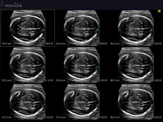 Fetal brain, MSV