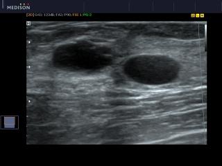 Brest cysts, SCI