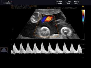 Umbilical vessels, CFM & PW