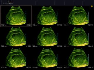 Liver tumor, MSV